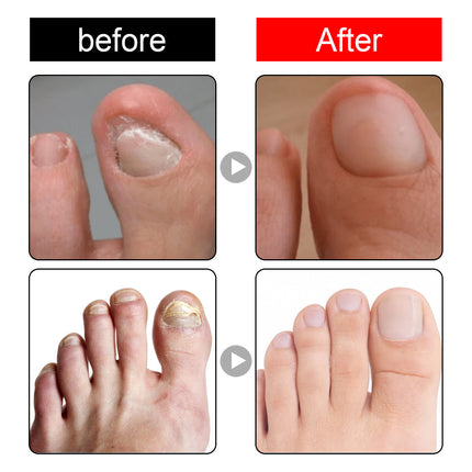South Moon Endogenous Nail Repair Nail Repair Cleaning Nail Removal Nail Care Essential Oil